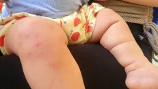 Một bệnh nhi mắc bệnh tay chân miệng với nhiều nốt ban. Ảnh: TTXVN.