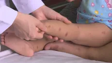 Các nốt phát ban của bệnh nhi bị tay chân miệng. Ảnh: Nguyên Dung/TTXVN.