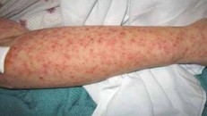 Dịch sốt Chikungunya lây lan tại thành phố Phật Sơn, Trung Quốc