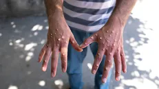 Bệnh nhân mắc đậu mùa khỉ ở châu Phi. 