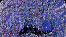 Giải bài toán “tàng hình” của tế bào ung thư