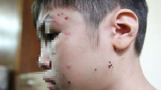 Vết thương và sẹo chằng chịt trên khuôn mặt cháu K.