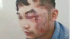 Anh Th. điều trị tại bệnh viện với nhiều vết thương.