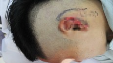 Một người đàn ông đã phải nhập viện tái tạo vành tai vì bị cắn nham nhở vành tai trái khi nhậu với bạn