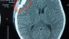 Hình ảnh chụp CT Scanner cho thấy sọ não cháu Điệp bị tổn thương nặng.