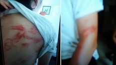 Bức ảnh chụp thương tích trên người cháu N.H.P sau trận đòn của bố do hàng xóm chụp lại. 