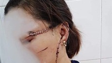 Những vết sẹo chằng chịt, lồi lõm trên khuân mặt chị O do bị chồng hờ dùng dao rạch.