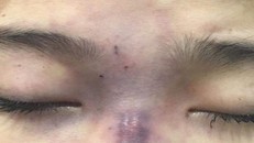 Cô gái 18 tuổi bị mù mắt do tiêm filler