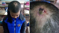 Hình ảnh thương tích trên đầu em Dĩnh do cô Nhuần chụp vào ngày 20/10/2018 (Ảnh do cô Phạm Thị Nhuần cung cấp cho PV)