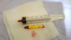 Đoạn bút chì do bệnh nhi 6 tuổi ngã phải. Ảnh: BVCC