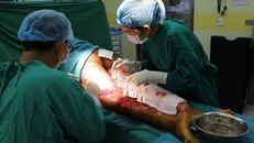 Các bác sĩ đang tiến hành cắt bỏ da bị hoại tử để tránh nhiễm trùng các khu vực lân cận
