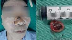 Hình ảnh nốt ruồi trên mũi ông Thanh khi đến khám (ảnh trái) và hình ảnh nốt ruồi được cắt bỏ sau phẫu thuật