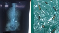 Các thanh nam châm trong ruột bệnh nhi trên phim X-quang (trái) và được lấy ra ngoài Ảnh: BVCC