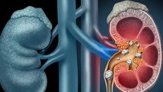 Phương pháp điều trị mới có thể tán sỏi thành bụi chỉ trong một lần điều trị