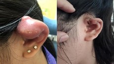 Theo các bác sĩ, biến chứng nguy hiểm và hay gặp nhất sau bấm lỗ tai, xỏ khuyên là viêm sụn vành tai. (Ảnh minh hoạ)