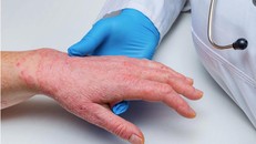 Bộ Y tế hướng dẫn các biện pháp phòng, chống tạm thời với bệnh đậu mùa khỉ