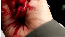 Nhà báo Đỗ Doãn Hoàng bị đánh bởi ít nhất 3 loại vật cứng