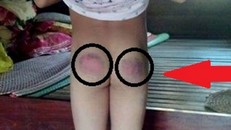 Dân mạng phẫn nộ cô giáo đánh tím mông học sinh vì không làm bài