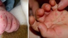 Có biểu hiện này hãy đưa trẻ đi khám bệnh chân tay miệng cấp tốc