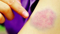 Có biểu hiện này bạn hãy đi khám ung thư máu ngay kẻo muộn