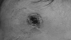 Viên đạn găm vào trán bên phải của cháu bé