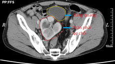 Hình ảnh chụp CT cho thấy thận phải lạc chỗ