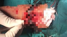 Các bác sĩ tiến hành vi phẫu nối động mạch cánh tay trái cho bé - Ảnh: Người Đưa Tin