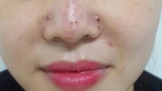 Mũi cô gái bị biến chứng sau khi tiêm filler.