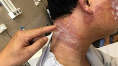 Tổn thương chằng chịt trên cổ, mặt, lưng của bệnh nhân sau 10 ngày bị sứa đốt. Ảnh: P.T.