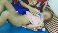 Bé trai 6 tuổi bị chó hàng xóm cắn nát mông, đùi khi chơi ở trong sân