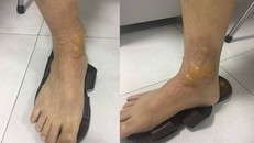 Vết bỏng ở chân bệnh nhân sau khi đi mát xa.