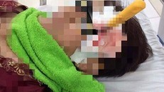 Dao gọt hoa quả cắm xuyên sọ người phụ nữ.