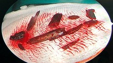 10 mảnh gỗ được lấy ra từ mắt bệnh nhân.