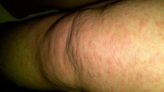 Người đàn ông sụt cả chục kilogam do mắc bệnh hiếm