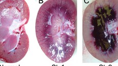 Nếu trả lời 'có' 6 câu hỏi này, thận của bạn có thể đã nhiễm độc nặng