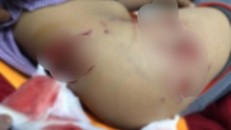 2 bé trai bị chó cắn sâu hoắm tận xương