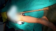Cháu bé bị thanh sắt đâm xuyên từ bộ phận sinh dục lên ổ bụng - Ảnh: Báo Giao thông