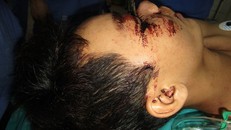 Lưỡi cưa cắm thẳng vào vùng giữa hai mắt bệnh nhân - Ảnh: Báo Công Lý