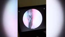 Con đỉa sống trong khe mũi phải của bệnh nhân suốt 3 tháng - Ảnh: Báo Hà Tĩnh