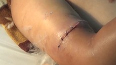 Cánh tay phải của bệnh nhân sau khi được nối lại - Ảnh: Công an TP.HCM