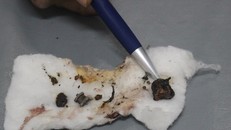 Các dị vật nằm trong hai bên phổi bệnh nhân được gắp ra ngoài - Ảnh: Thanh Niên