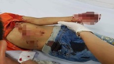 Cháu K. bị đa chấn thương được cấp cứu tại bệnh viện - Ảnh: Báo Công Lý