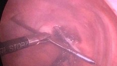 Hình ảnh gỡ chiếc đinh khổng lồ ra khỏi nhu mô phổi - Ảnh: VTC News