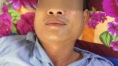 Cả nhà lây quai bị cho nhau, chồng và con phải nhập viện vì biến chứng