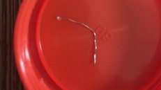 Thanh kẽm dài 7 cm được lấy ra ngoài - Ảnh: Báo Người Lao Động