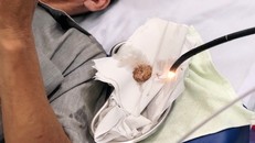 Miếng thịt heo đường kính khoảng 5cm được gắp ra - Ảnh: TTXVN