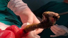 Búi tóc khổng lồ gây tắc ruột cho bé gái - Ảnh: Pháp luật TP.HCM