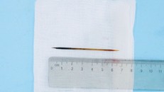 hiếc tăm dài khoảng 7cm được lấy ra từ bụng bệnh nhân - Ảnh: Báo Người đưa tin