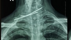 Hình ảnh X-quang cho thấy cây kim đâm xuyên thực quản và khí quản bệnh nhân - Ảnh: Sức khỏe Đời sống