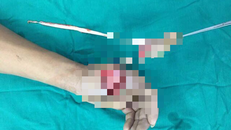 Đứt lìa ngón tay vì bình gas mini phát nổ